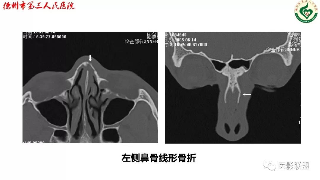 鼻骨骨折影像,鼻骨骨折dr影像表现