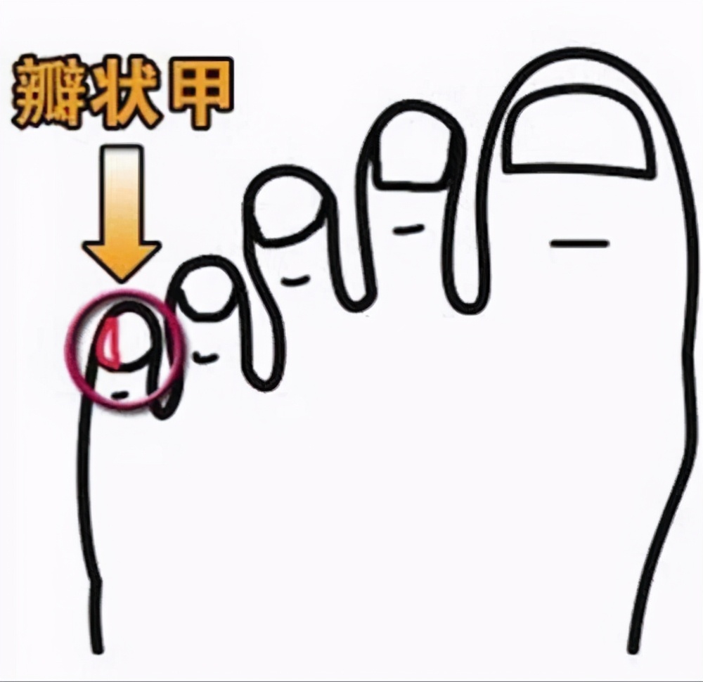 为什么小脚趾甲几乎是一坨,小脚趾甲分成两瓣