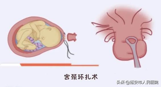 宫颈机能不全患者的福音丨宫颈环扎术