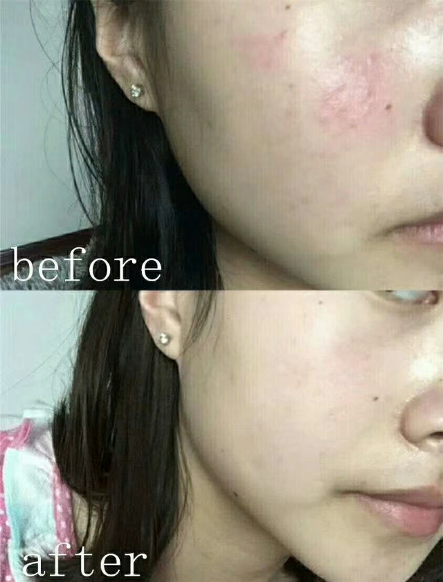 快速缓解痘痘泛红的办法,怎么祛除红血丝敏感痘痘
