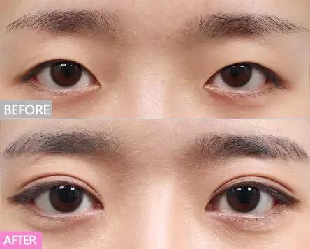 不建议做双眼皮的三种情况,为什么不建议做双眼皮