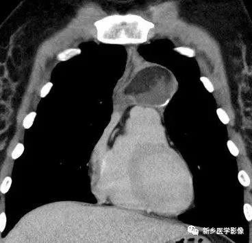 胸腺增生和纵隔肿瘤的区别和症状,纵隔胸腺肿瘤的常见临床症状表现