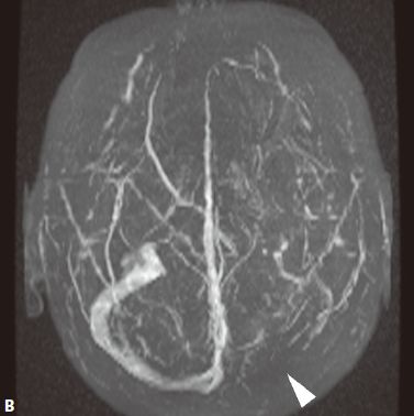 颅内血管周围间隙的影像鉴别,颅脑血管源性疾病影像诊断