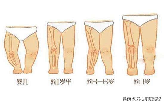儿童o型腿可以学步吗,宝宝学步时怎么会导致o型腿