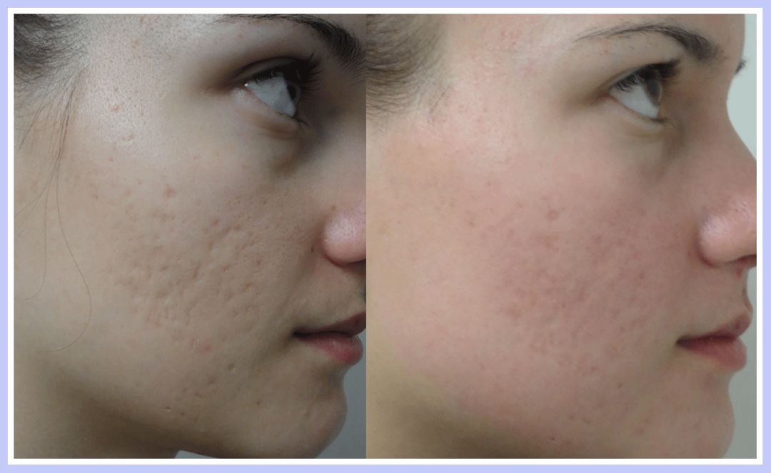 痘印痘坑目前治疗方法哪个最好,医美机构靠药物去痘印痘坑可靠吗