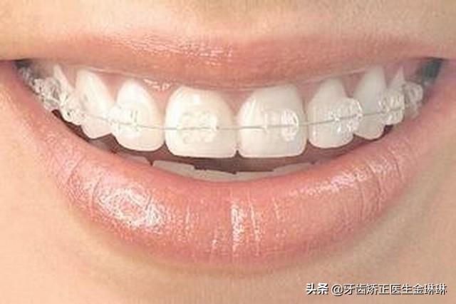 各种牙套的优缺点是什么,各个牙套的优缺点