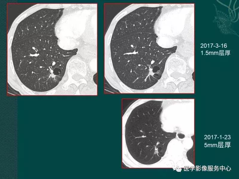 肺癌复查出现多发索条状阴影,肺癌影像学表现