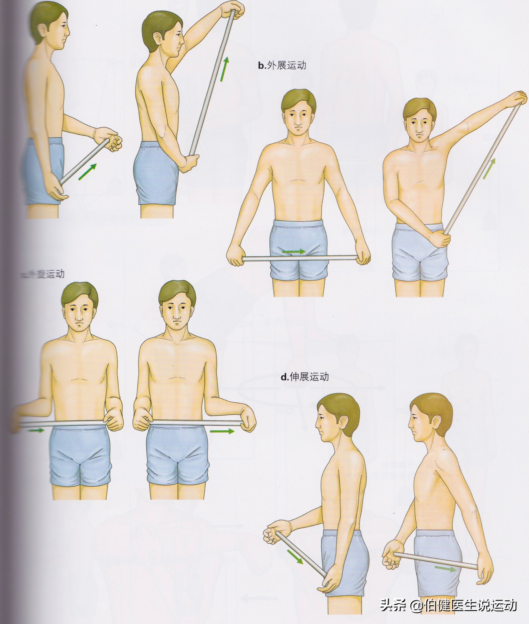 肩袖三级撕裂保守治疗效果,肩袖撕裂保守治疗的方法