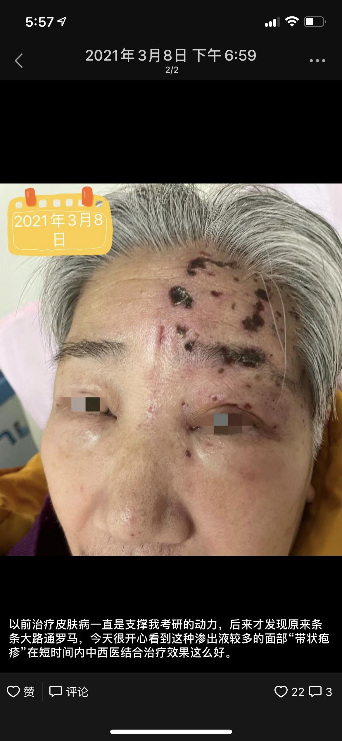 带状疱疹吃中药好还是西药好,带状疱疹后遗神经痛的中药方