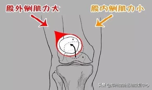 髌骨软化症吃什么食物好,自我判断髌骨软化症视频