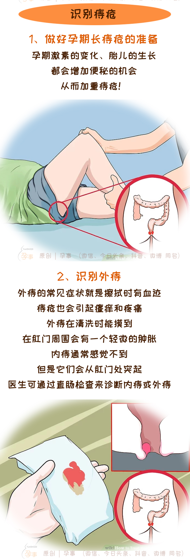 怀孕分娩后痔疮大爆发，三个步骤正确护理缓解疼痛