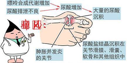 足痛风的快速止痛的方法,中医治疗痛风的穴位