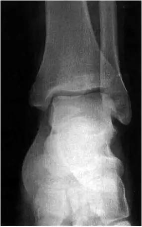 踝关节撞击症问诊,踝关节撞击综合征的x线表现