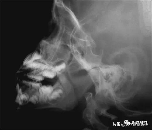 腺样体肥大有必要做x射线复查吗,最简单检测腺样体肥大的方法