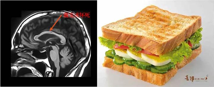 胼胝体有什么症状,胼胝体形态较小可以治疗吗