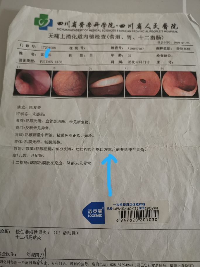 一个逆转的萎缩性胃炎患者自述,萎缩性胃炎被逆转了