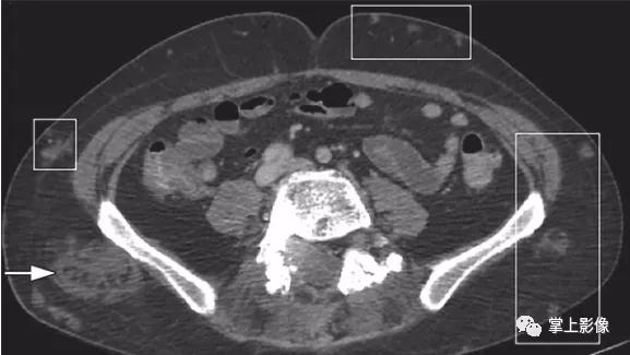腹壁病变诊断思路,腹部影像诊断读片入门视频