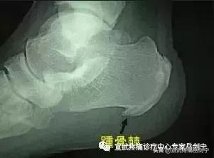 脚后跟尿酸堆积痛怎么缓解,缓解脚后跟痛踩台阶视频