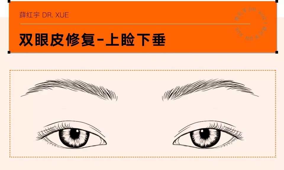 双眼皮整形修复,潘贰双眼皮修复