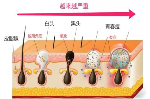 追剧却怕皮肤出油，不花钱的2种NG方式，几点挽救毛孔粗大