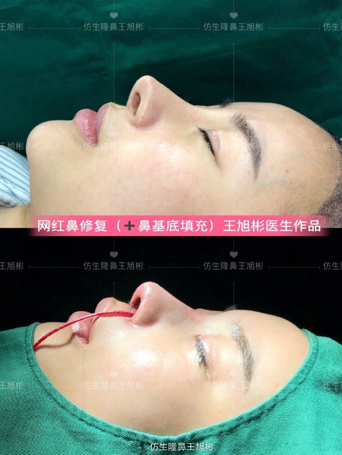 窄鼻子如何通过鼻整形来矫正,宽鼻子矫正方法