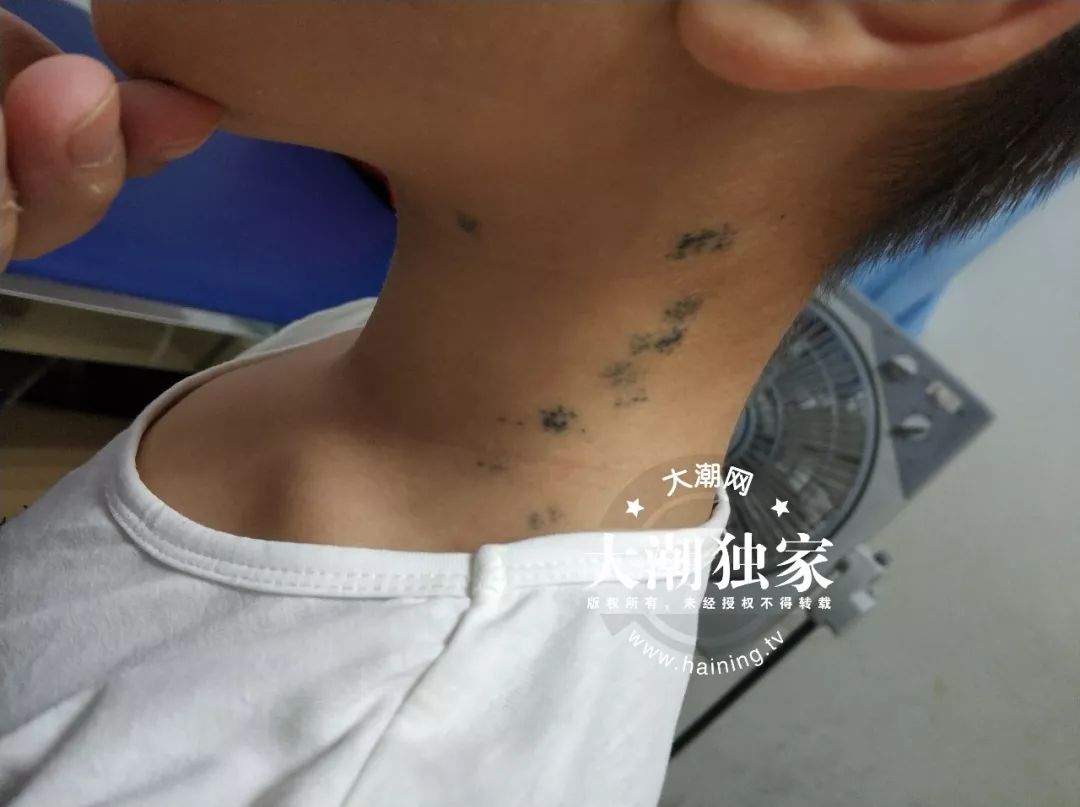 10岁男孩脖子上起肉刺是怎么回事,触目惊心孩子