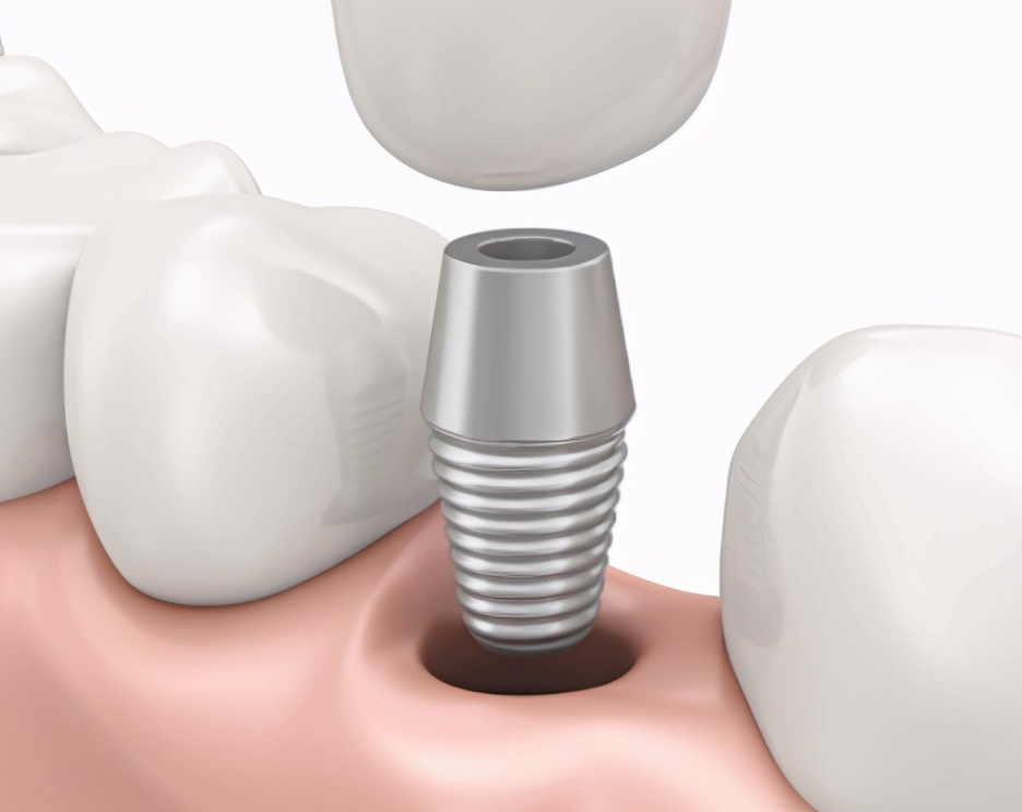 种植牙手术怎么操作,种植牙手术全过程是什么样的