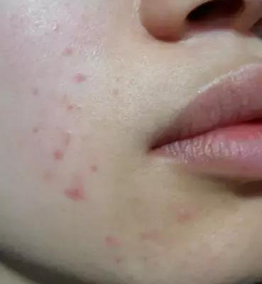 脖子上长痣小肉粒,脖子上长小肉粒要注意啦