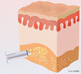 戴牙套真的会出现牙套脸,戴牙套期间牙齿变龅了