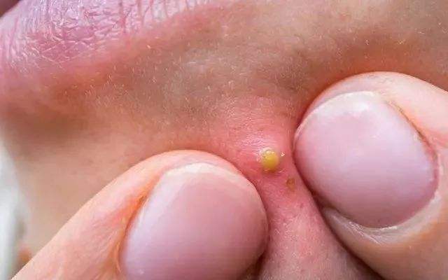 脸上痘痘一直反反复复怎么回事,脸上痘痘一直反复长痘印消不下去