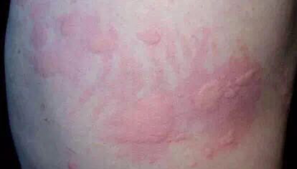 宝宝湿疹皮炎怎么治,宝宝湿疹脂溢性皮炎