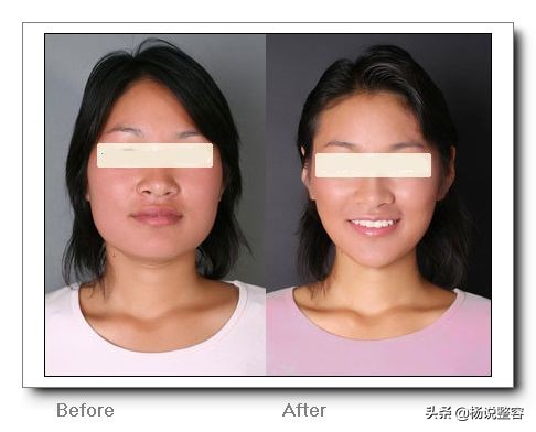 为什么会下颌突出,为什么下颌角突出