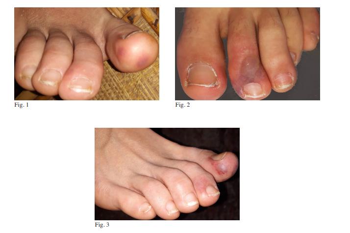 最新新冠肺炎病例的症状,新冠肺炎患者新症状