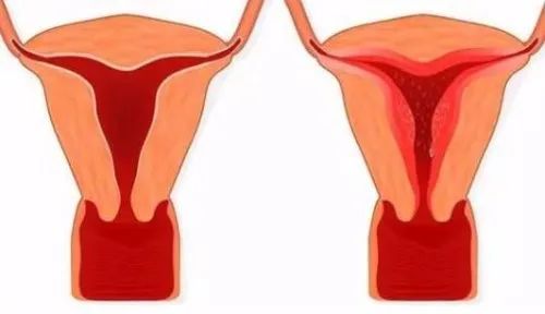 子宫内膜厚月经淋漓不尽,子宫内膜厚注意不能吃什么