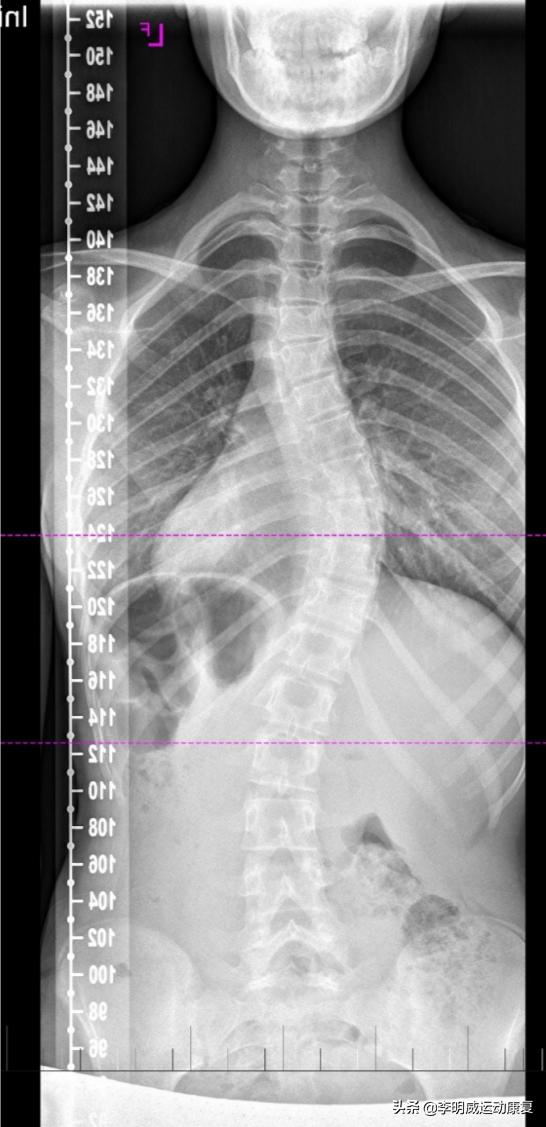 脊柱侧弯自我矫正最好的方法,孩子脊柱侧弯怎么办图片