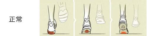 偏瘫足内翻足外翻,足内翻足外翻崴脚