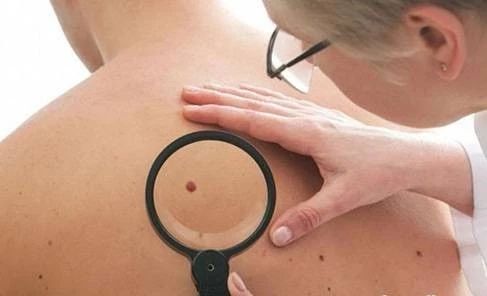 脚底有痣会得癌症是真的吗,痣越长越大就是癌症的可能吗