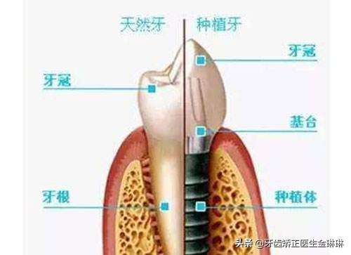 老年人多颗牙齿缺失解决方案,多颗牙齿缺失安活动假牙