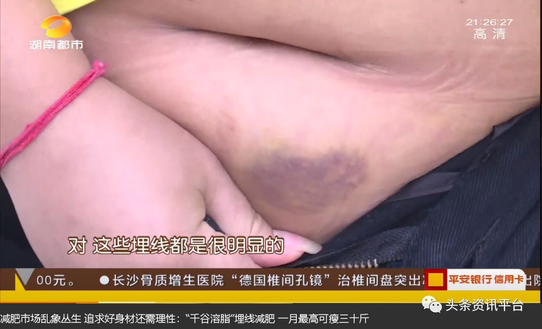 千谷生物科技,千谷高端溶脂线真的能瘦吗