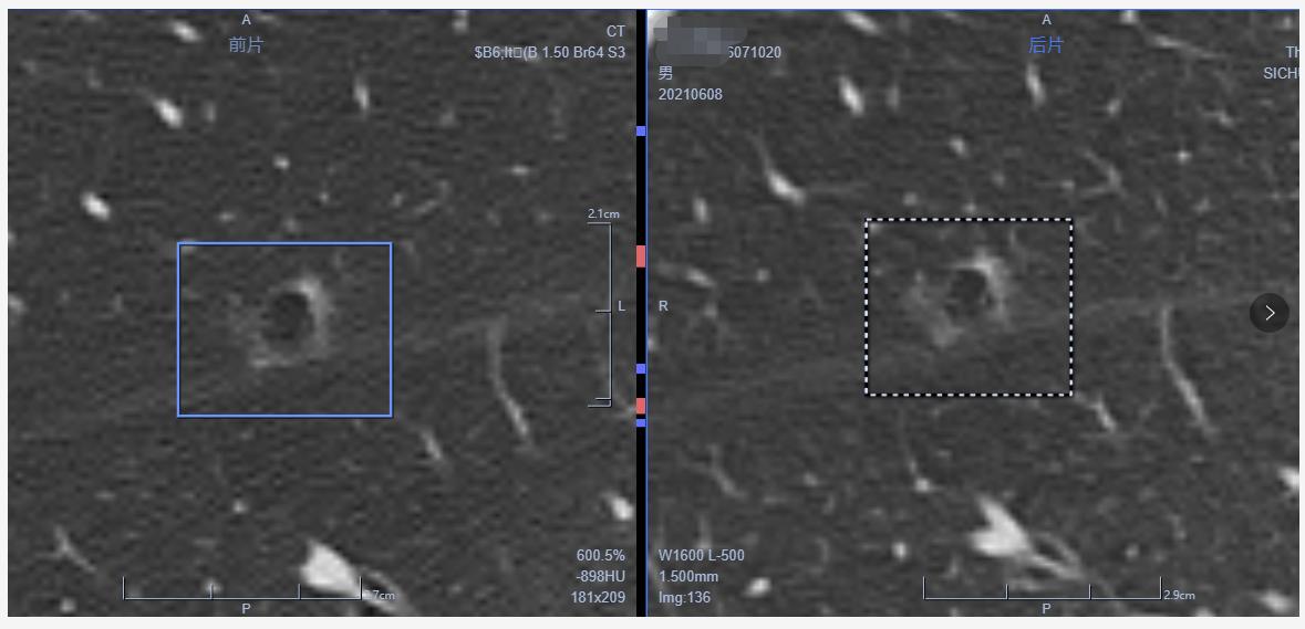 肺结节看诊（七）：这个肺结节手术太及时，空泡征小结节要注意