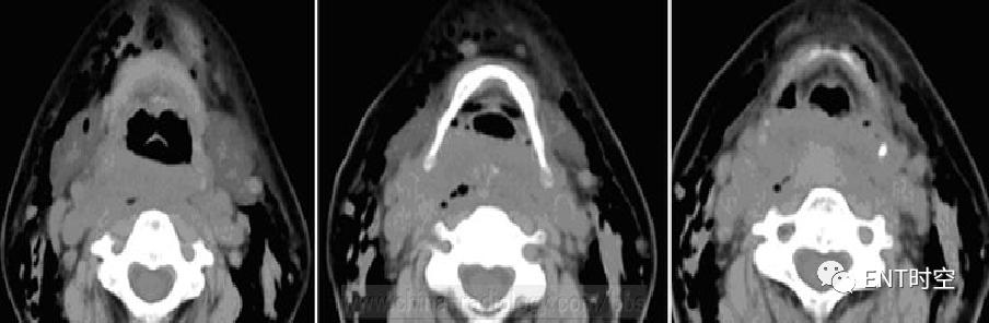 主任读片会：六大「喉部典型病例」大饱眼福