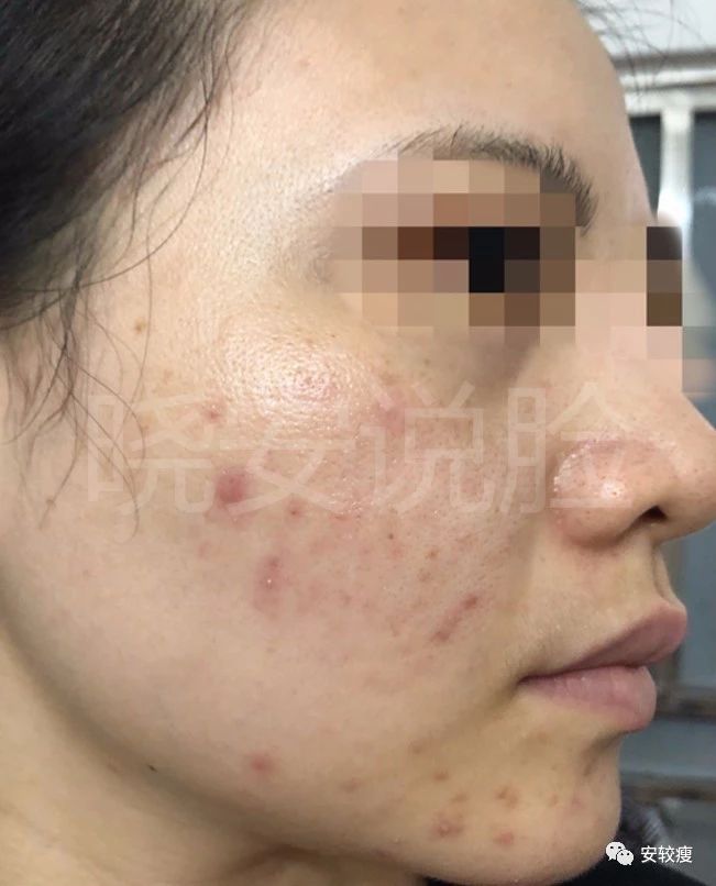 外油内干敏感痘肌怎么护肤,30岁油皮痘痘敏感肌怎么改善