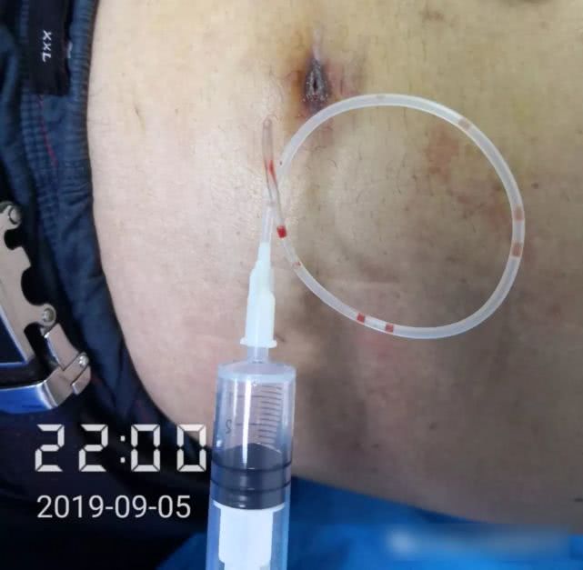 阑尾炎形成窦道的原因,阑尾炎一孔微创手术全过程