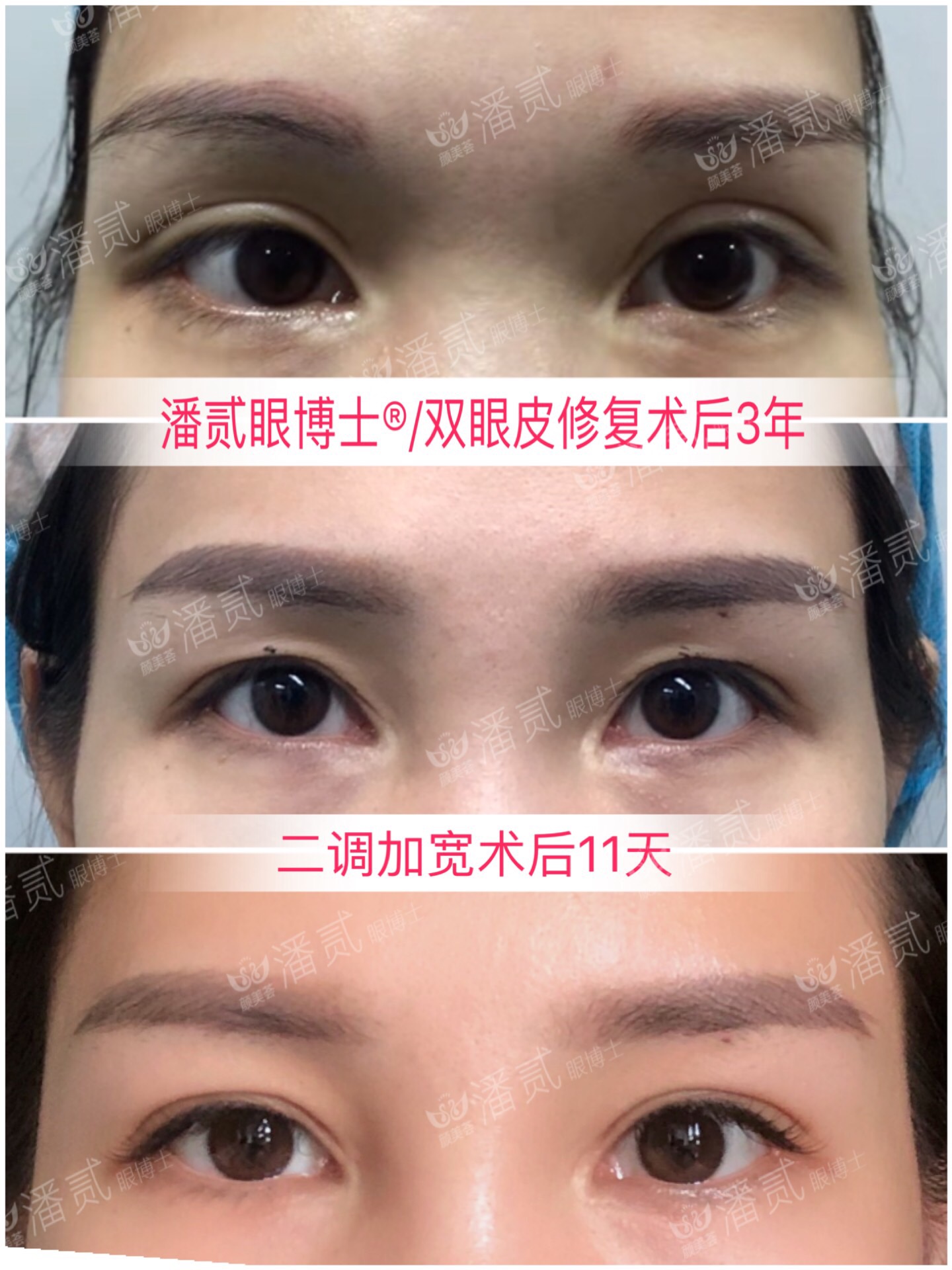 请别再怀疑潘贰做双眼皮手术切肌肉了，希望这是我最后一次澄清