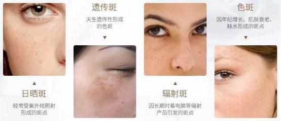 吉米祛斑怎么使用视频,吉米的祛斑产品真的可以祛斑吗