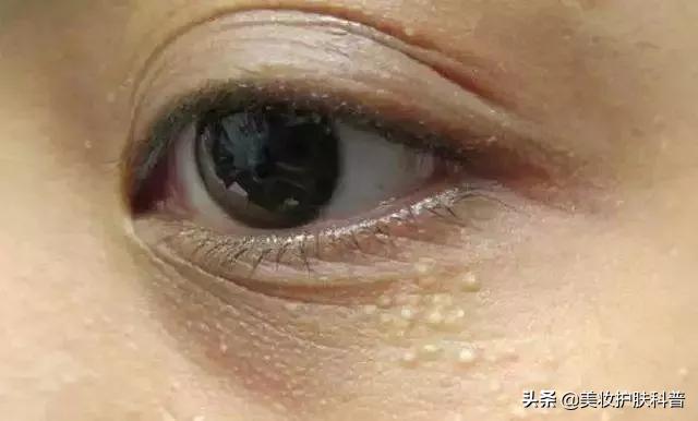 怎样避免眼周长脂肪粒,10%尿素霜可以治疗眼周脂肪粒吗