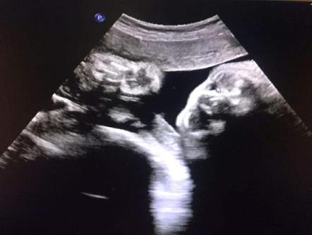 胎儿左右眼内侧无回声鼻泪管囊肿,胎儿鼻泪管囊肿超声诊断