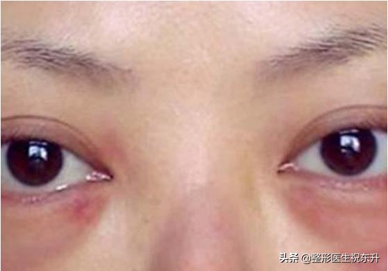 做完眼袋手术防止内睑外翻的手法,做完眼袋手术眼袋又出来了