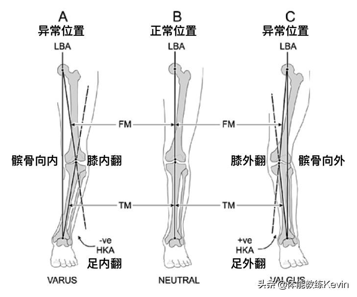 一个动作改善足外翻,足外翻怎么练习走路姿势