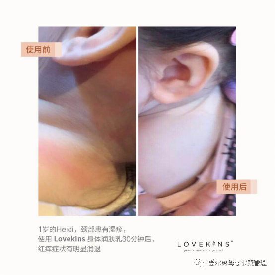 手痒湿疹反复发作如何除根,8岁湿疹反复发作如何除根